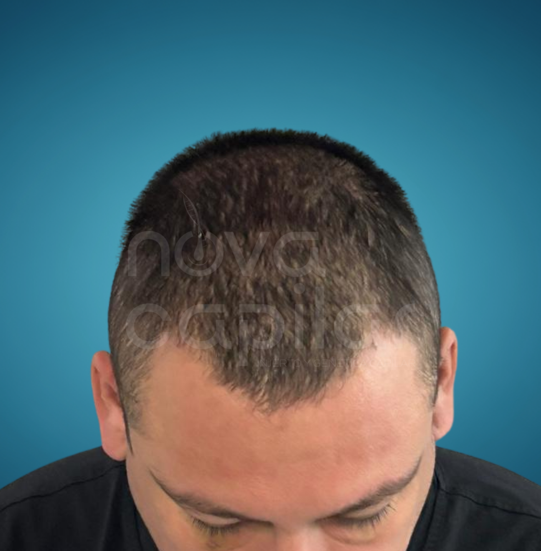 injerto-capilar-saltillo-monterrey-regenera-botox-clinica-estetica-nova-capilar-