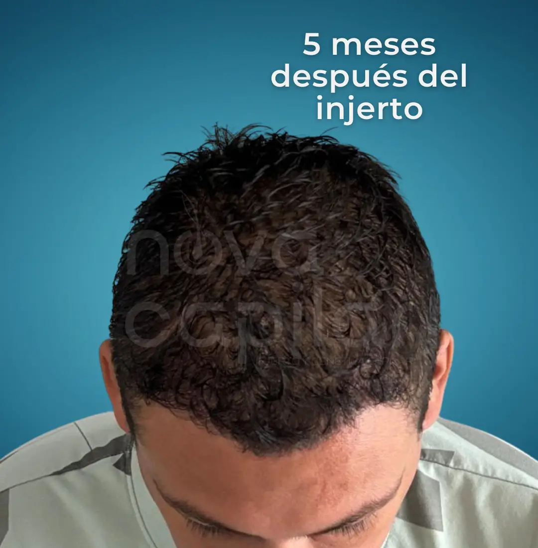 injerto-capilar-saltillo-monterrey-regenera-botox-clinica-estetica-nova-capilar- (1) injerto-capilar-saltillo-monterrey-regenera-botox-clinica-estetica-nova-capilar- (1)