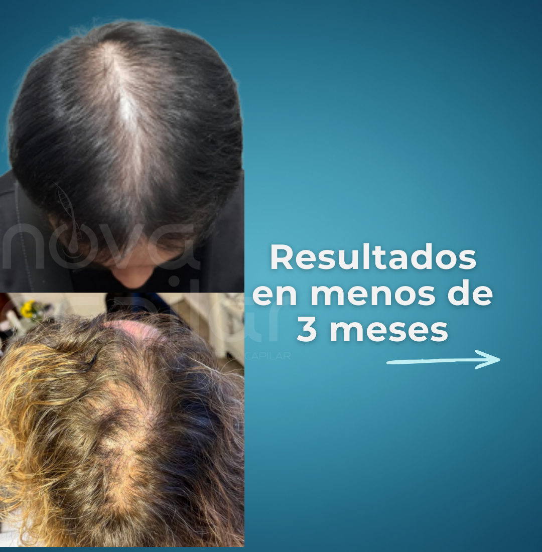 injerto-capilar-saltillo-monterrey-regenera-botox-clinica-estetica-nova-capilar- (2)