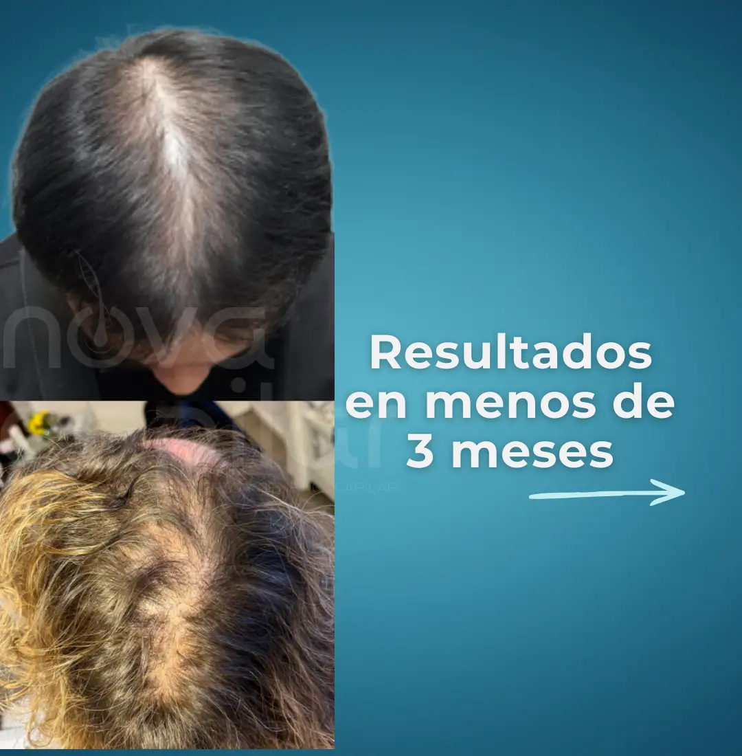 injerto-capilar-saltillo-monterrey-regenera-botox-clinica-estetica-nova-capilar- (2) injerto-capilar-saltillo-monterrey-regenera-botox-clinica-estetica-nova-capilar- (2)