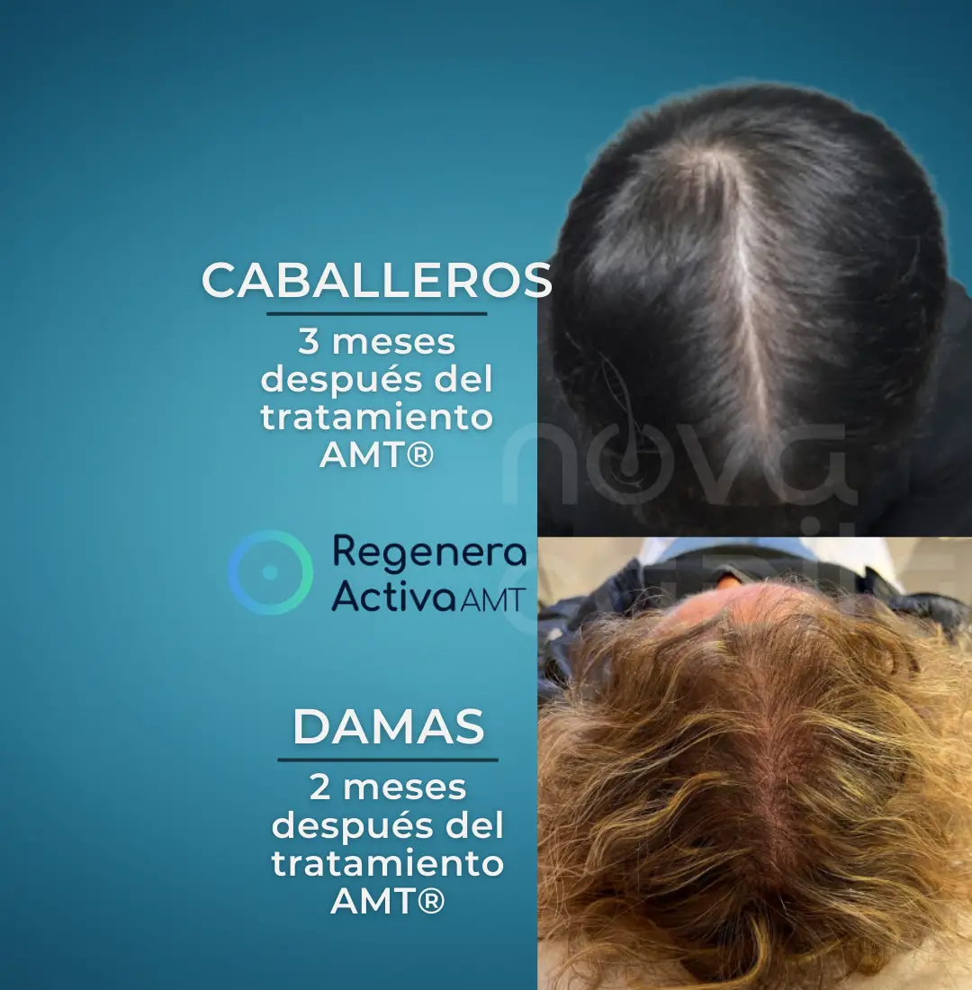 injerto-capilar-saltillo-monterrey-regenera-botox-clinica-estetica-nova-capilar- (3) injerto-capilar-saltillo-monterrey-regenera-botox-clinica-estetica-nova-capilar- (3)